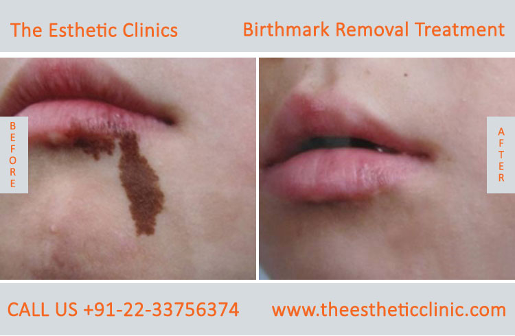 Birthmarks Removal Treatment before after photos in mumbai india (2)